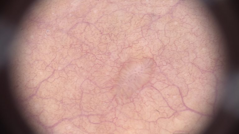 Feigwarzen – Bosch & Bosch