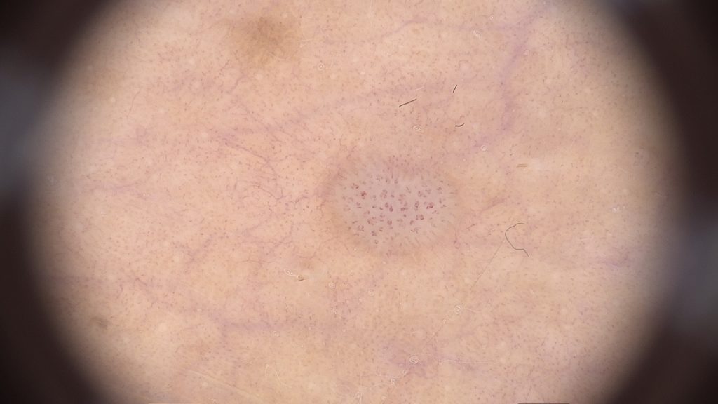 Feigwarzen – Bosch & Bosch